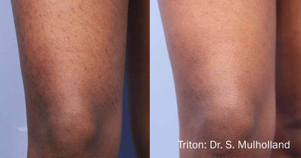 epilation laser triton avant apres